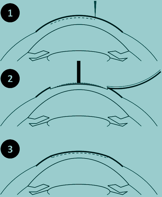 technique LASIK astigmatisme
