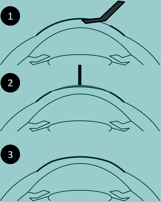 technique PKR astigmatisme