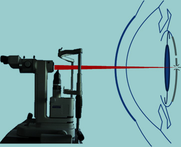 cataracte secondaire au laser