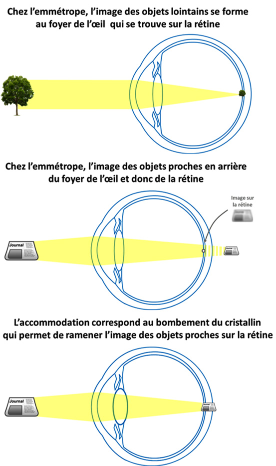 l'oeil hypermétrope