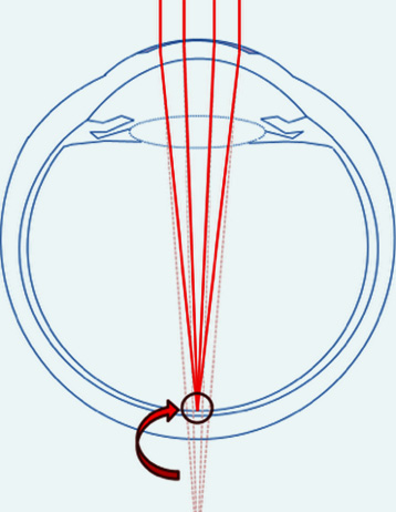 Opération de l'hypermétropie par laser
