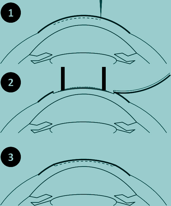 technique LASIK hypermétropie