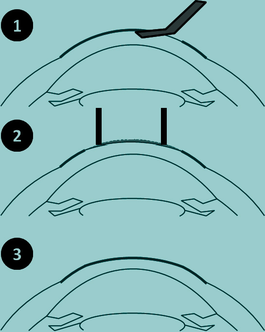 technique PKR hypermétropie