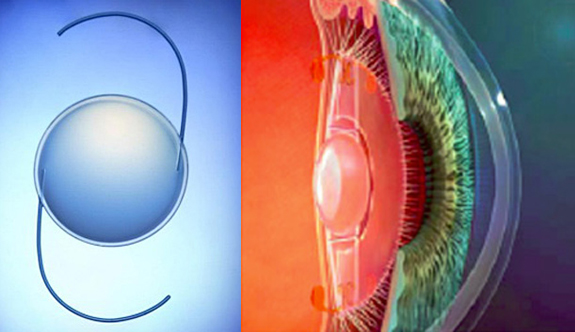 déroulement de la chirurgie