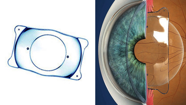 déroulement de la chirurgie