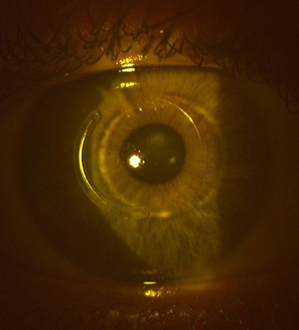 La technique des anneaux intra-cornéens