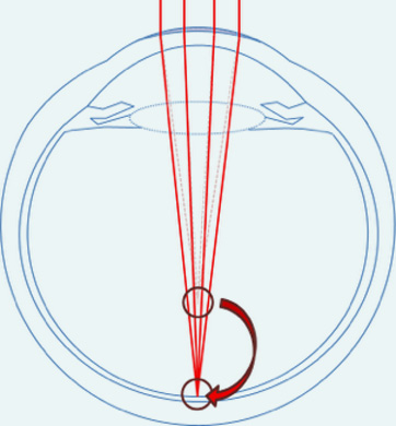 Opération de la myopie par laser