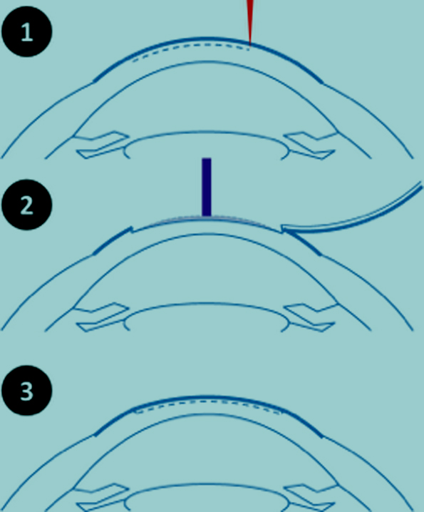 technique LASIK myopie