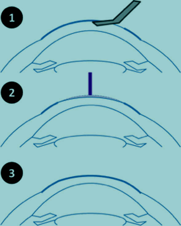technique PKR myopie