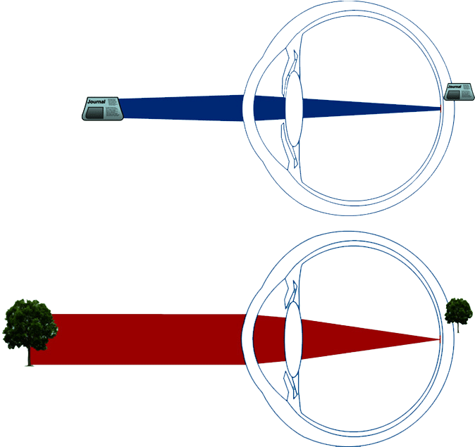 Opération de la presbytie par laser
