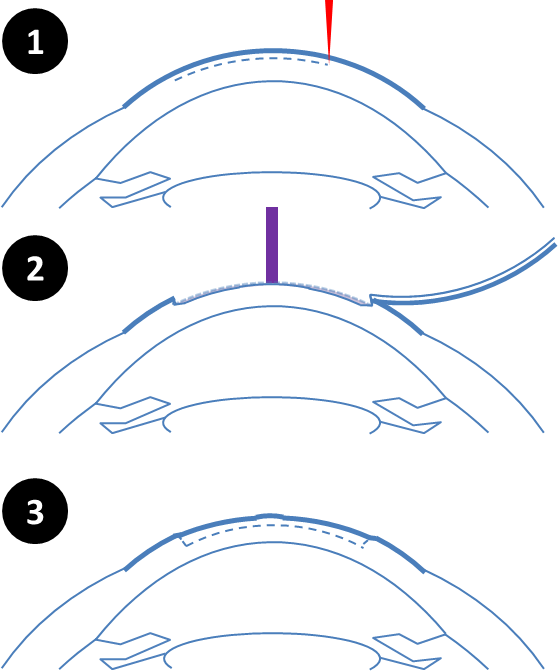 technique PresbyLASIK pour la presbytie
